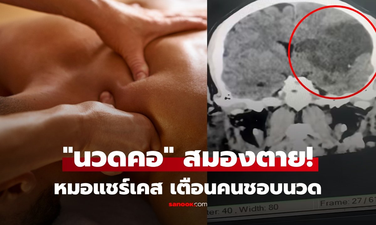 เตือนภัยนวดคอผิดวิธี! แพทย์แชร์เคสชายสมองตาย ชี้จุดอันตรายเสี่ยงสโตรกถึงชีวิต