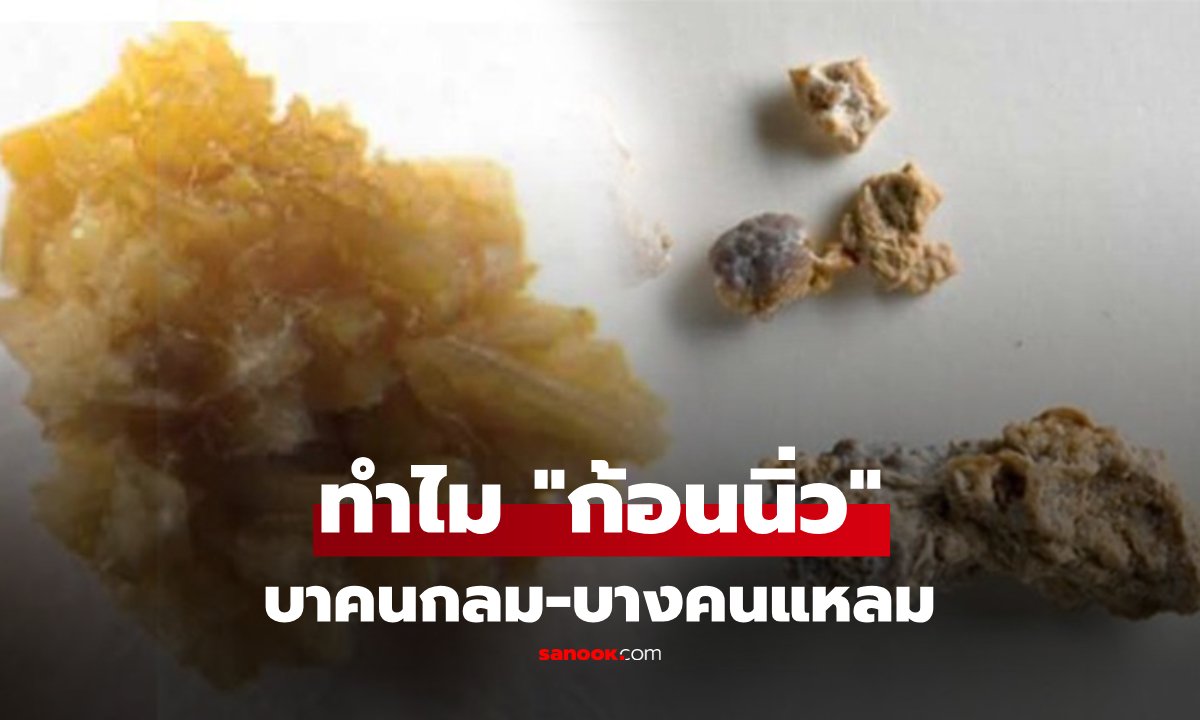 ไขความลับ 'ก้อนนิ่ว' ทำไมบางก้อนกลมเกลี้ยง บางก้อนแหลมคมเหมือนปะการัง?