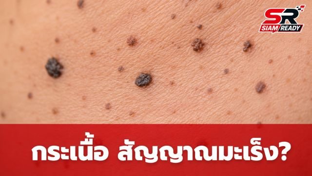 อย่าชะล่าใจ! แพทย์เตือน 'กระเนื้อ' ขึ้นผิดปกติ อาจเป็นสัญญาณเตือนมะเร็งร้าย