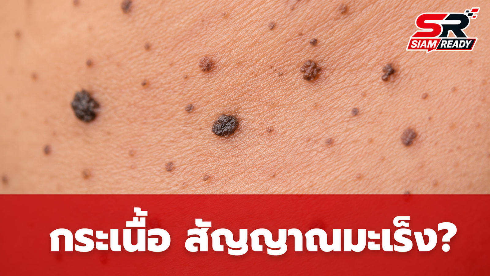 อย่าชะล่าใจ! แพทย์เตือน 'กระเนื้อ' ขึ้นผิดปกติ อาจเป็นสัญญาณเตือนมะเร็งร้าย