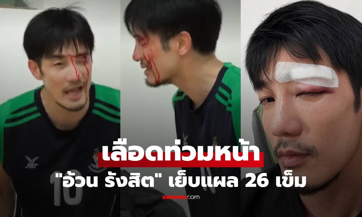 อ้วน รังสิต ประสบอุบัติเหตุลูกบาสกระแทกหน้า เย็บแผลรวม 26 เข็ม