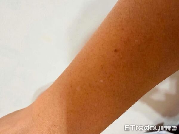 ไขข้อสงสัย 'จุดขาว' บนผิวหนังวัย 40+ คืออะไร? หมอเผยไม่ใช่โรคด่างขาว