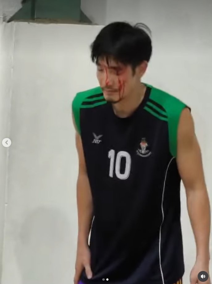 อ้วน รังสิต ประสบอุบัติเหตุลูกบาสกระแทกหน้า เย็บแผลรวม 26 เข็ม