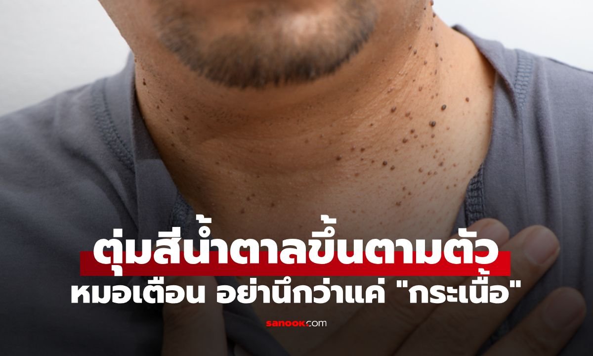 อย่าชะล่าใจ! แพทย์เตือน 'กระเนื้อ' ขึ้นผิดปกติ อาจเป็นสัญญาณเตือนมะเร็งร้าย