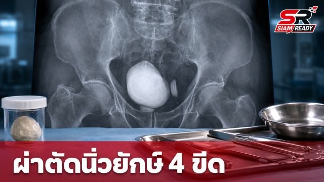 แพทย์ผ่าตัดนิ่วยักษ์หนัก 420 กรัม ออกจากกระเพาะปัสสาวะชายวัย 86 ปี