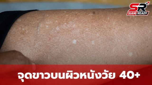 ไขข้อสงสัย 'จุดขาว' บนผิวหนังวัย 40+ คืออะไร? หมอเผยไม่ใช่โรคด่างขาว