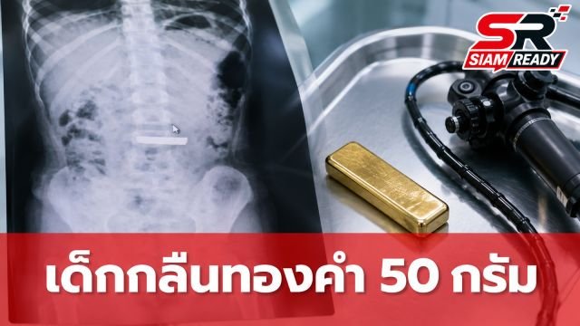แพทย์จีนเร่งช่วยชีวิตเด็กหญิงวัย 5 ขวบ หลังกลืนทองคำแท่ง 50 กรัมลงท้อง