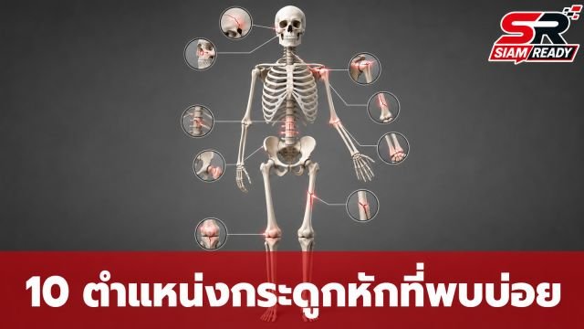 เปิดสถิติ 10 ตำแหน่งกระดูกหักที่พบบ่อยที่สุดทั่วโลก ชี้เพศชายเสี่ยงสูงกว่าจากกิจกรรมผาดโผน