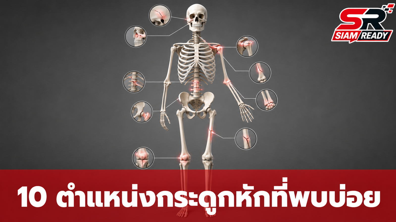 เปิดสถิติ 10 ตำแหน่งกระดูกหักที่พบบ่อยที่สุดทั่วโลก ชี้เพศชายเสี่ยงสูงกว่าจากกิจกรรมผาดโผน