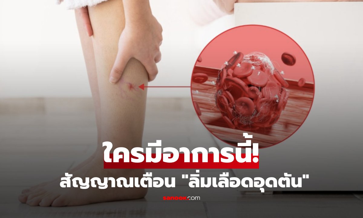 เตือนภัย! อาการขาบวมข้างเดียว สัญญาณอันตรายจากภาวะลิ่มเลือดอุดตัน