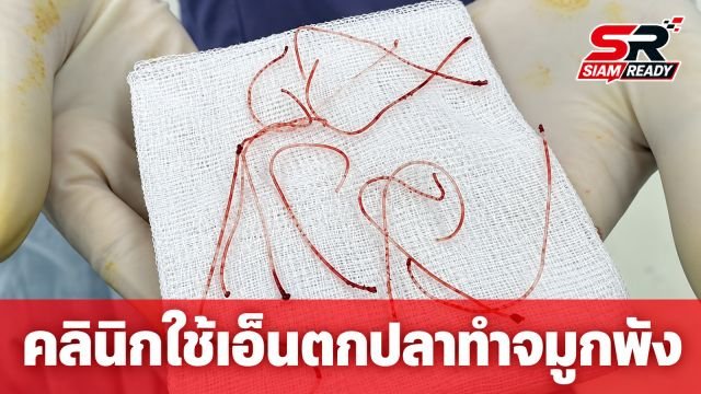 เหยื่อคลินิกเสริมความงามรวมตัวแจ้งความ หลังพบร้อยไหมด้วย 'สายเอ็นตกปลา' ทำจมูกอักเสบพัง