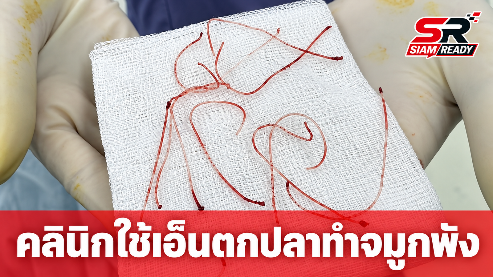 เหยื่อคลินิกเสริมความงามรวมตัวแจ้งความ หลังพบร้อยไหมด้วย 'สายเอ็นตกปลา' ทำจมูกอักเสบพัง