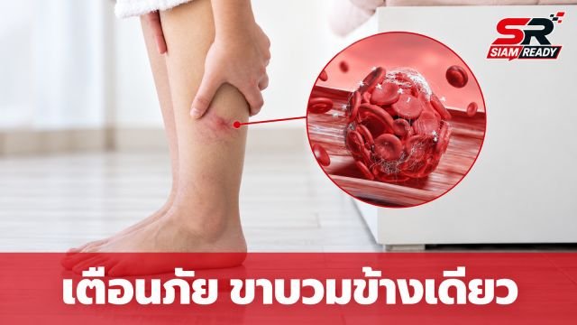 เตือนภัย! อาการขาบวมข้างเดียว สัญญาณอันตรายจากภาวะลิ่มเลือดอุดตัน