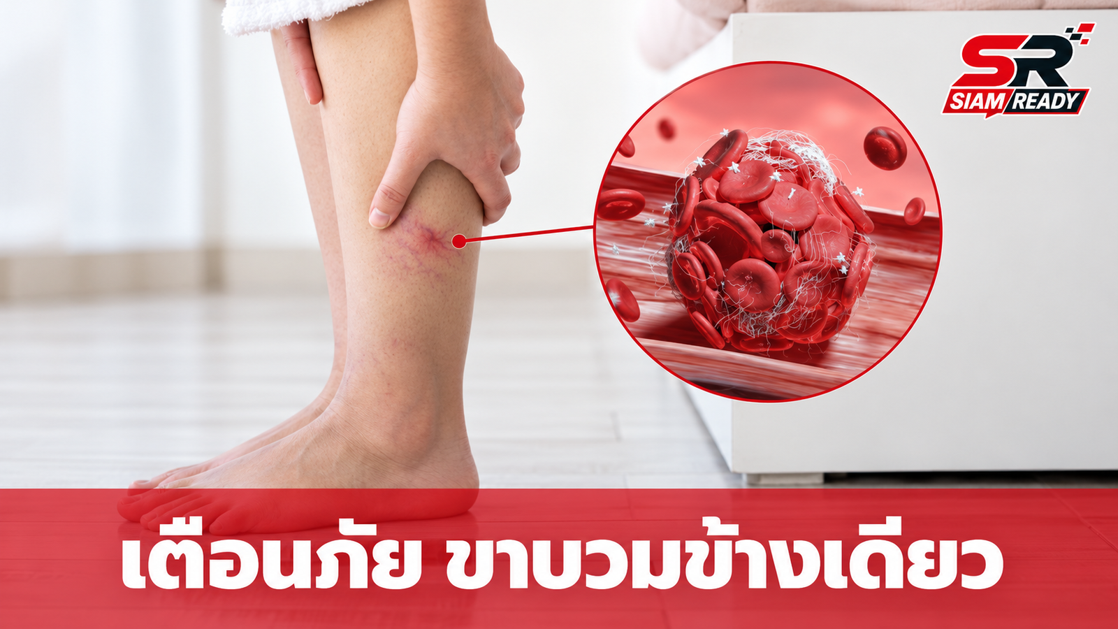 เตือนภัย! อาการขาบวมข้างเดียว สัญญาณอันตรายจากภาวะลิ่มเลือดอุดตัน