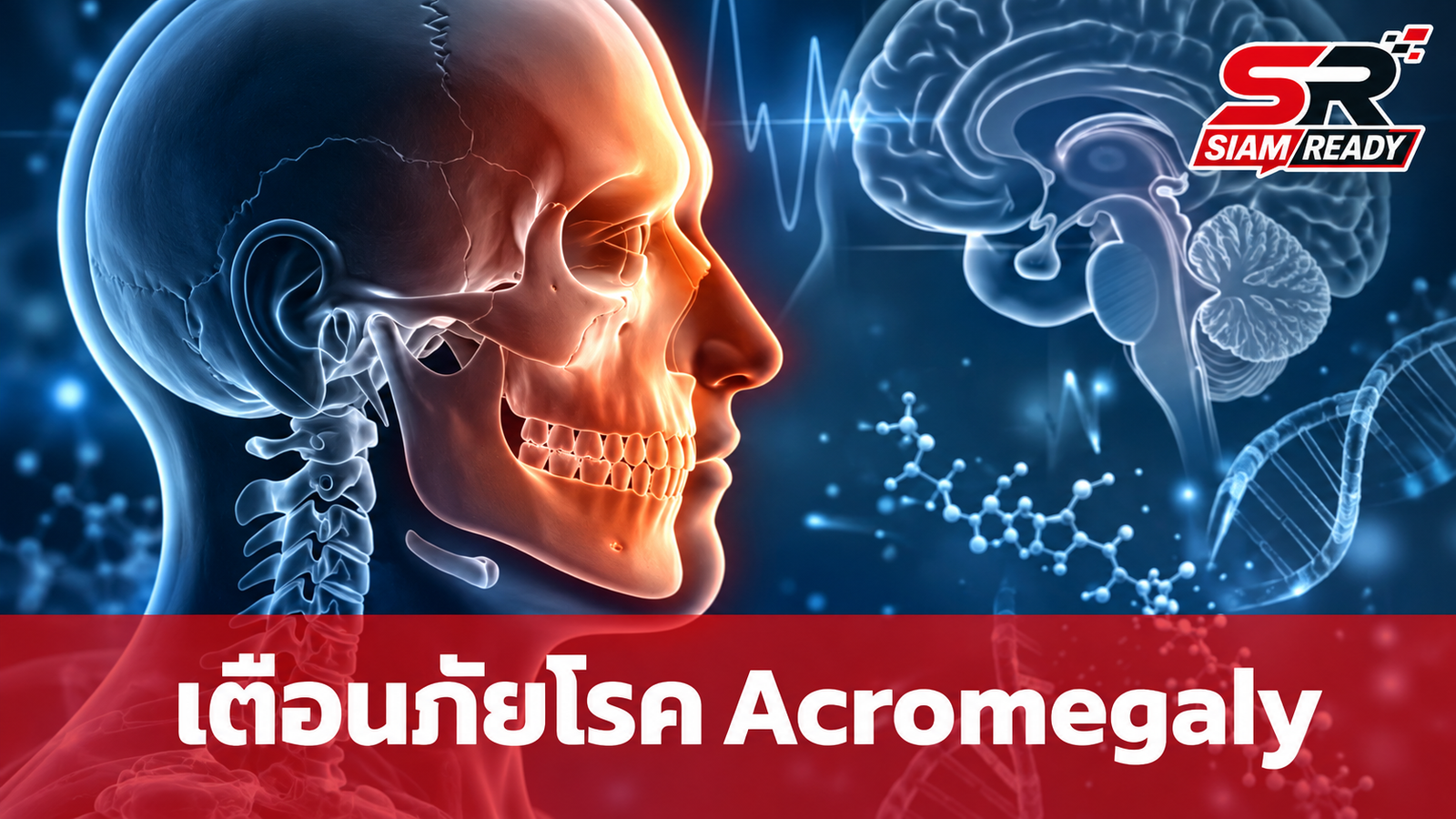 รพ.ราชวิถี เตือนภัยโรค Acromegaly ภาวะฮอร์โมนโตผิดปกติในวัยผู้ใหญ่