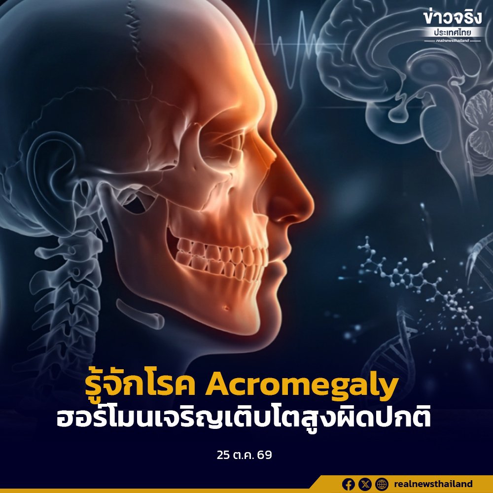 รพ.ราชวิถี เตือนภัยโรค Acromegaly ภาวะฮอร์โมนโตผิดปกติในวัยผู้ใหญ่