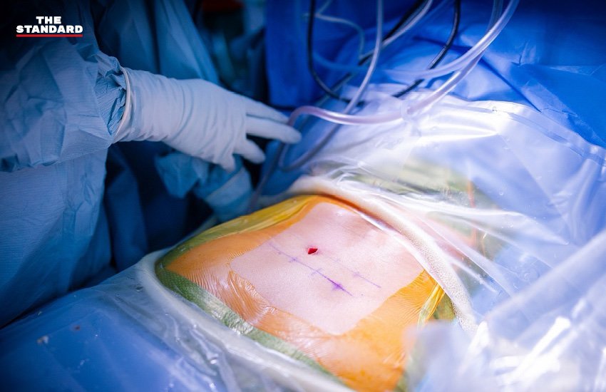 ก้าวใหม่แห่งการผ่าตัดกระดูกสันหลัง: เปิดมุมมอง Endo-Fusion กับ อ.นพ.วิทย์ โคธีรานุรักษ์